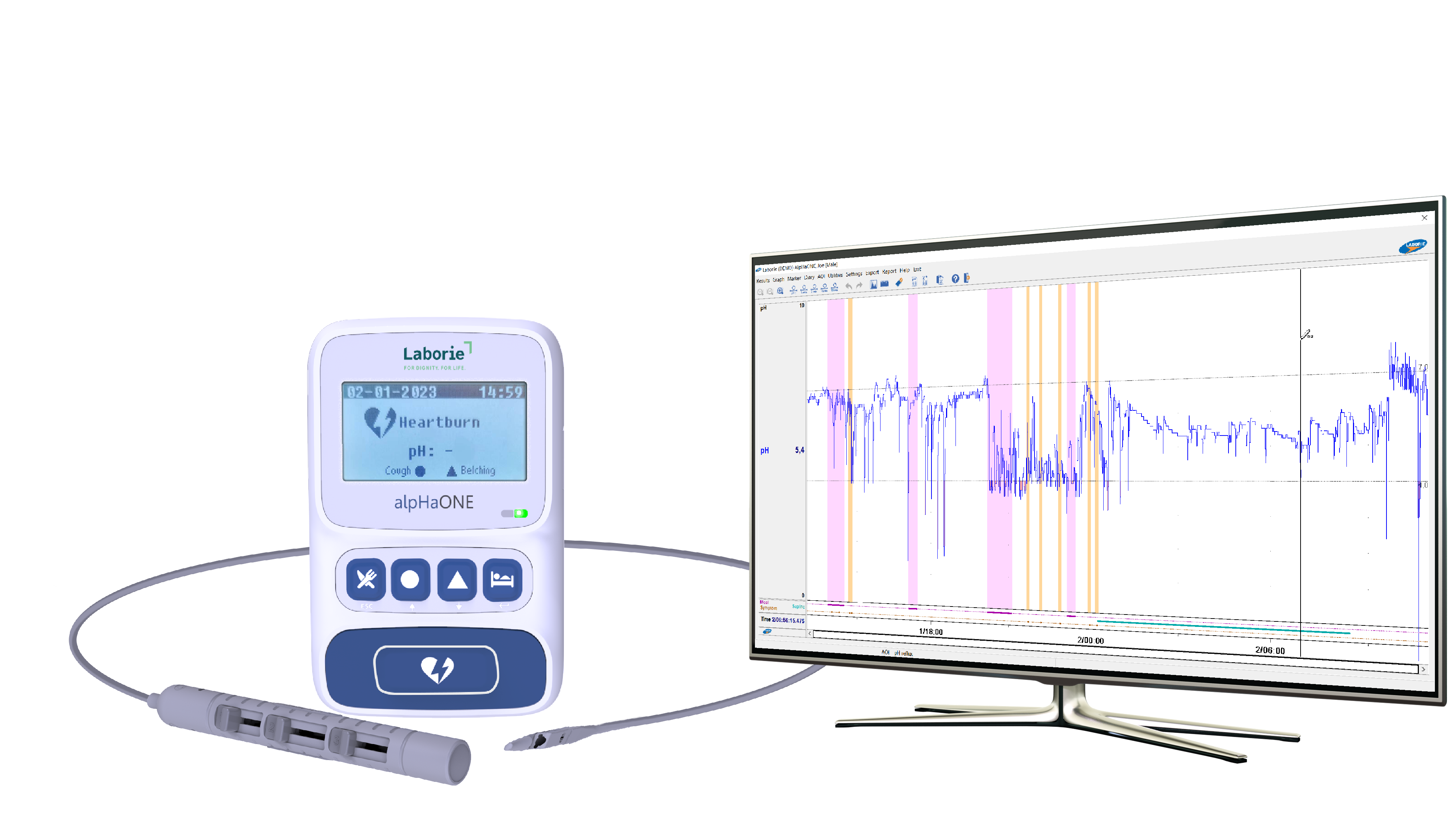 alpHaONE Wireless pH Capsule Reflux Monitoring System for the Treatment of GERD