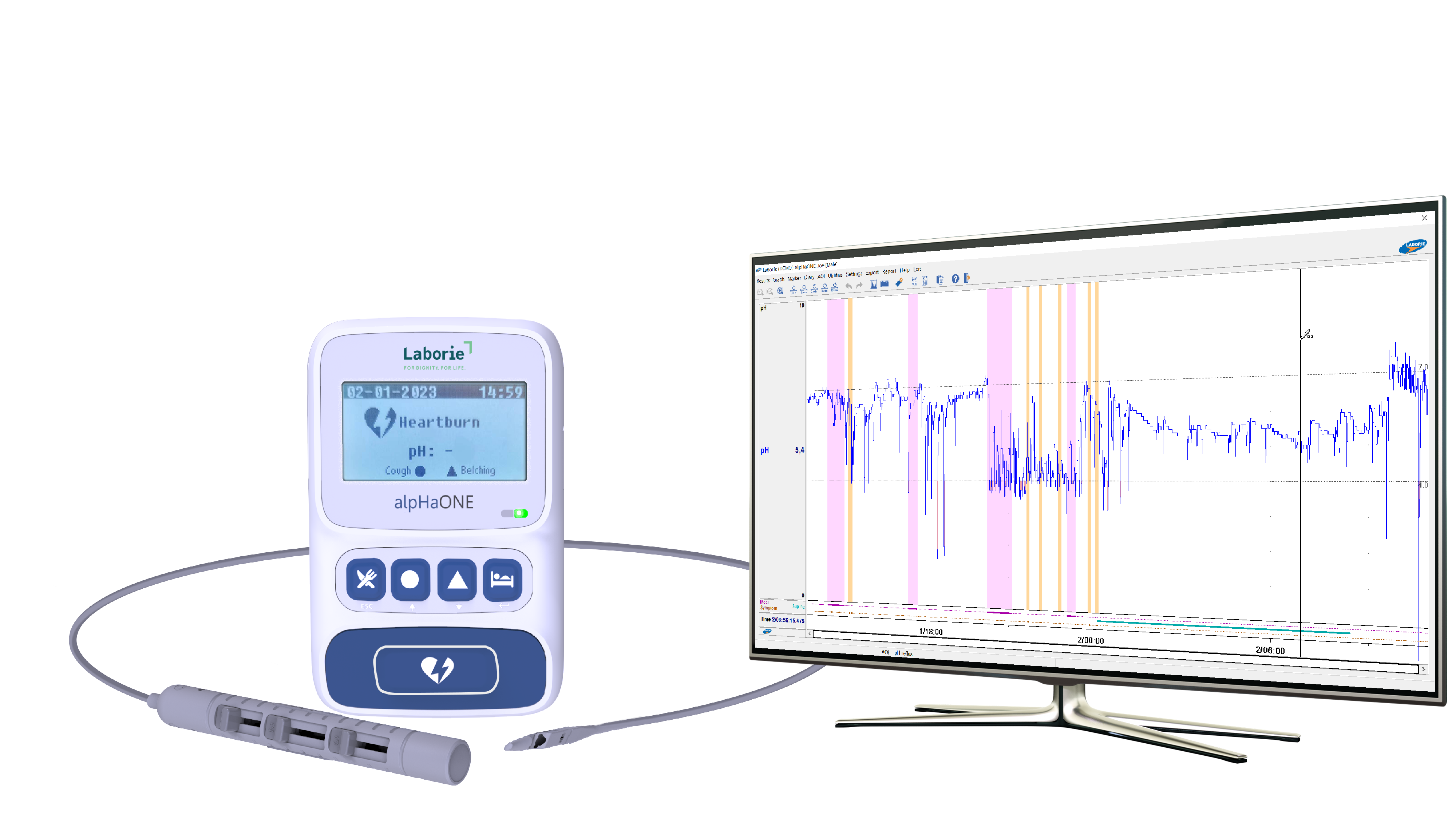 alpHaONE Wireless pH Capsule Reflux Monitoring System for the Treatment of GERD