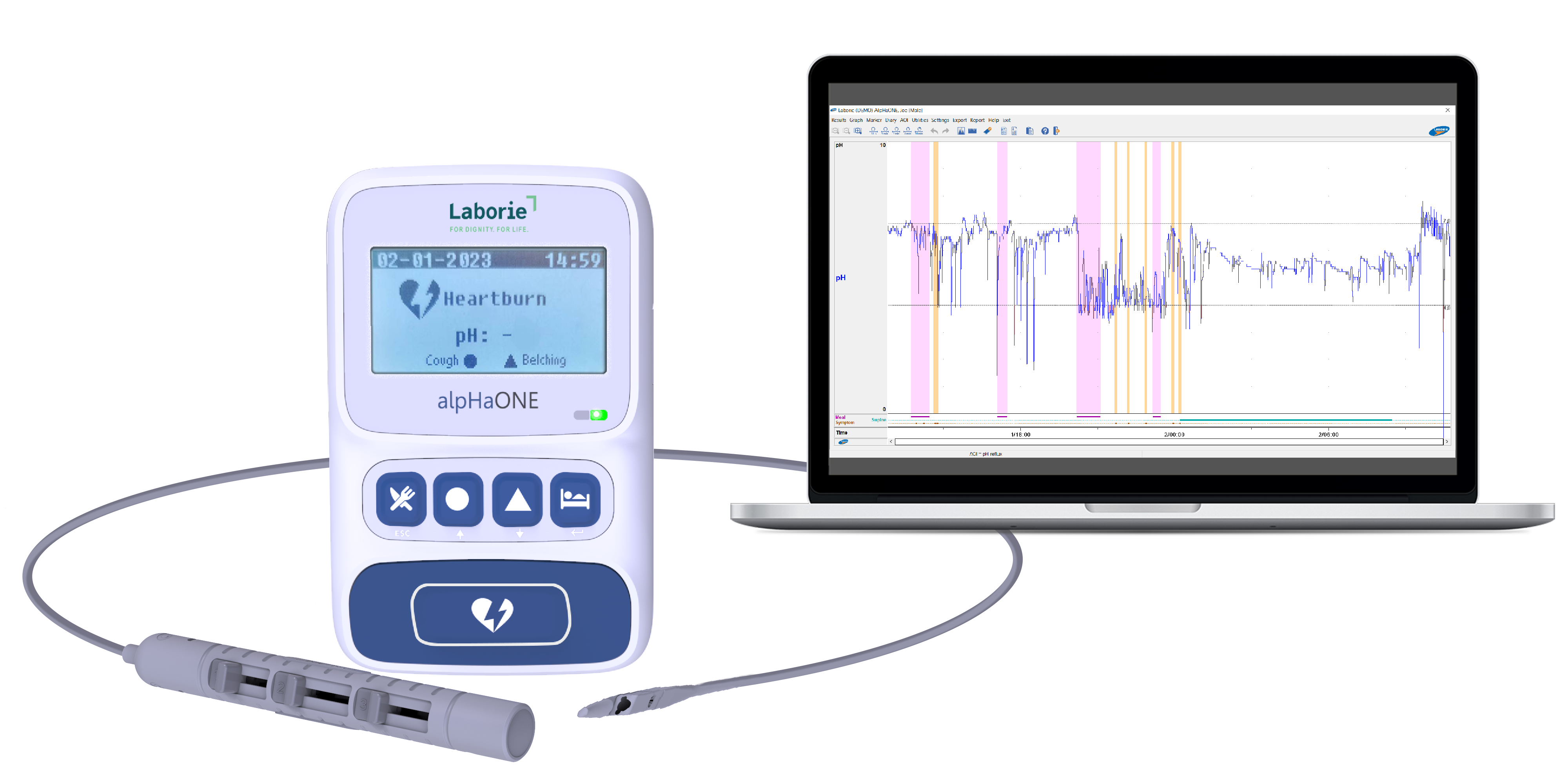 alpHaONE Wireless pH Capsule Reflux Monitoring System for the Treatment of GERD